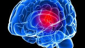 Medical illustration of a brain tumor