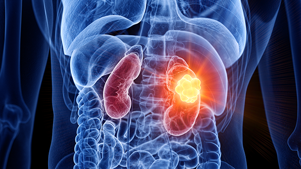 Medical illustration of a kidney tumor