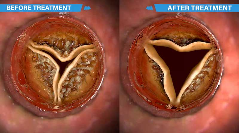 Aortic valve before and after treatment