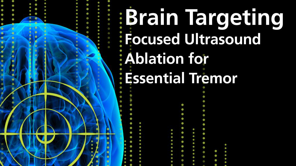 Brain Targeting - Focused Ultrasound Ablation for Essential Tremor