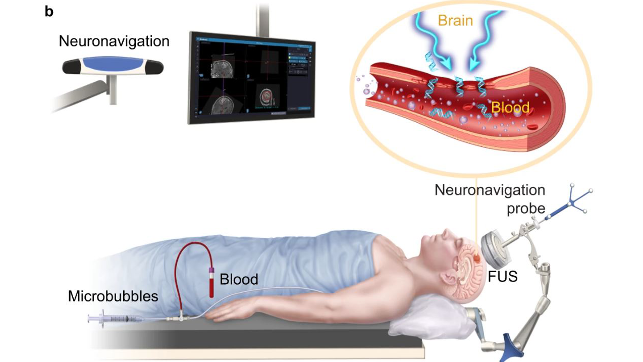 Illustration of the neuronavigation-guided sonobiopsy setup. 